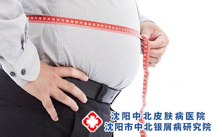 銀屑病脫皮是什么癥狀