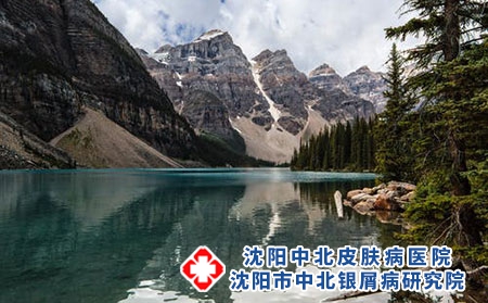 沈陽哪里有治療牛皮癬的哪家好