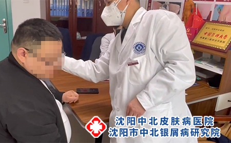 沈陽哪家看銀屑病醫院好?【沈陽銀屑病醫院賈建新醫生】