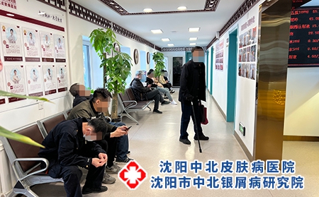 沈陽專業治銀屑病-沈陽地區牛皮癬醫院
