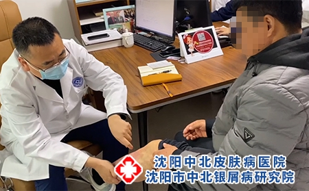 沈陽哪家治銀屑病-沈陽在哪治療銀屑病