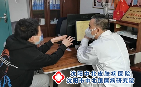 沈陽的銀屑病治療-沈陽銀屑病到哪里治