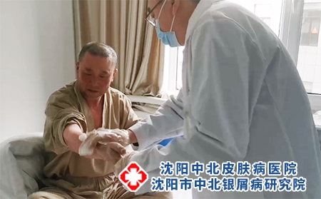 沈陽看銀屑病醫院-沈陽哪銀屑病治的好