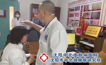 沈陽有看銀屑病正規(guī)的醫(yī)院嗎-沈陽有哪些醫(yī)院專治牛皮癬呢
