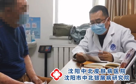 沈陽看銀屑病去哪-沈陽哪些治療銀屑病