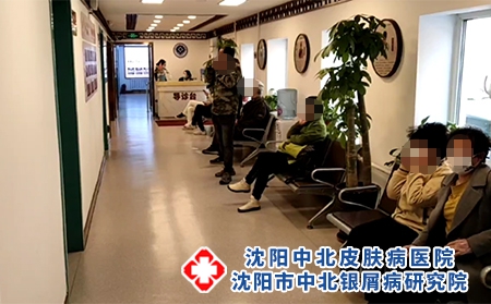 沈陽醫(yī)院治銀屑病-沈陽哪有治牛皮癬的