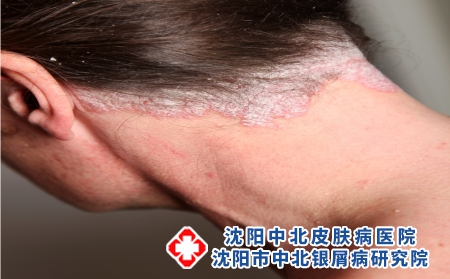 攝圖網_327944171_嚴重皮絲蟲病     頸部（企業商用）