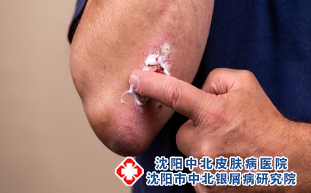 攝圖網_326508286_使用軟膏作為藥物劑型治療皮膚病的概念照片 患者在肘部區域特寫的皮膚上引起醫療軟膏稠度或乳霜保濕劑（企業商用）