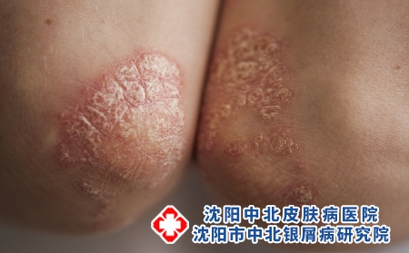 攝圖網_326238053_身穿白色T恤的年輕女子手肘皮膚上的絲蟲病癥狀發癢皮炎疾病衛生保健濕疹皮膚科女性女孩（企業商用）