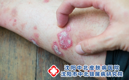 攝圖網_323551465_絲蟲病藥品手臂皮炎宏觀彎頭疾病剝皮醫療衛生身體（企業商用）