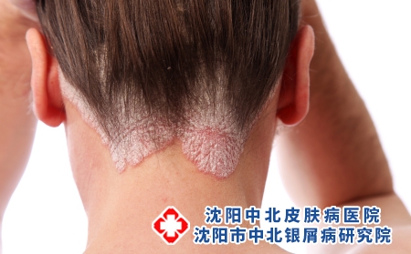 攝圖網(wǎng)_327927894_毛發(fā)和頭皮上的psorpalpic（企業(yè)商用）