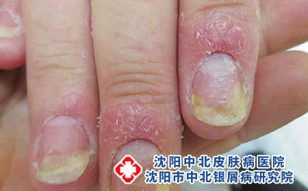 指甲牛皮癬1