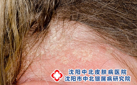 頭皮牛皮癬3