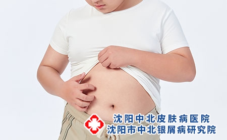 攝圖網(wǎng)_501687663_青少年兒童皮膚瘙癢（企業(yè)商用）