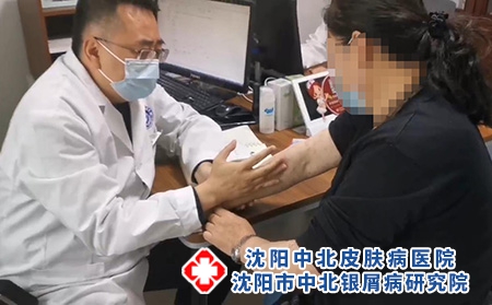 沈陽看銀屑病費(fèi)用-沈陽哪治療銀屑病好