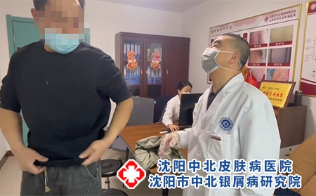 沈陽銀屑病?？颇?沈陽到哪看牛皮癬好