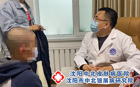 沈陽銀屑病咨詢網-沈陽牛皮癬醫院好嗎