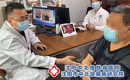 沈陽銀屑病哪家好-沈陽牛皮癬治療哪好