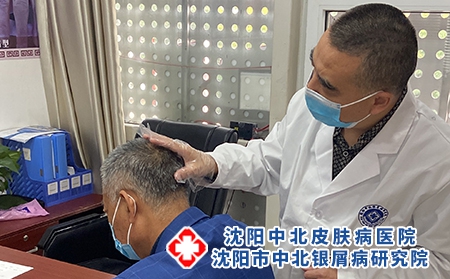 沈陽治銀屑病好的-沈陽牛皮癬醫(yī)院正規(guī)