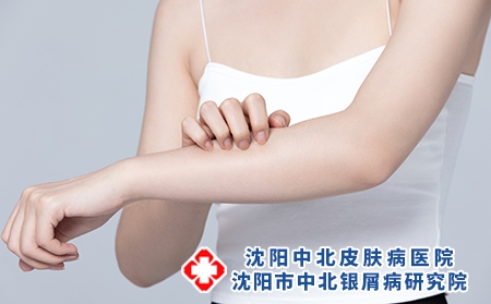 攝圖網_501700721_皮膚過敏抓撓手臂的女性（企業商用）