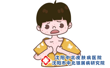 攝圖網_401360863_過敏（企業商用）