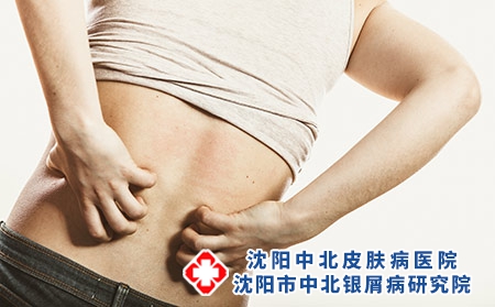 攝圖網(wǎng)_304129678_人類抓癢的背皮膚過(guò)敏疹健康問(wèn)題（企業(yè)商用）