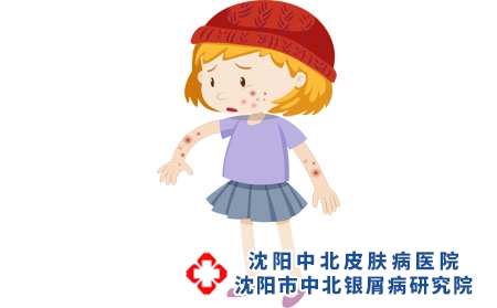 攝圖網(wǎng)_401477102_長濕疹的女孩（企業(yè)商用）