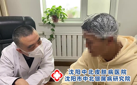沈陽銀屑病名中醫(yī)-沈陽牛皮癬防治醫(yī)院