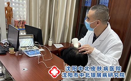 沈陽中醫(yī)銀屑病治-沈陽牛皮癬能治好嗎