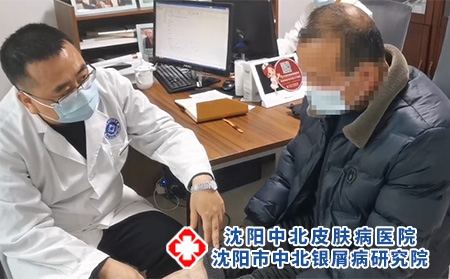 沈陽哪里看銀屑病-沈陽哪家專治銀屑病