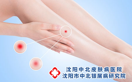 攝圖網_500774826_皮膚發炎（企業商用）