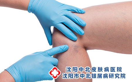 攝圖網_303522806_醫生親手檢查女腿和緊閉的容器上變血管（企業商用）