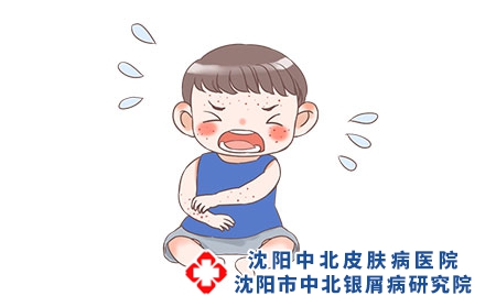 攝圖網_401762381_兒童濕疹（企業商用）