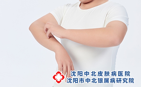 攝圖網_501687661_青少年兒童皮膚瘙癢（企業商用）