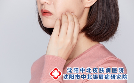 攝圖網_501684066_女性被蚊蟲叮咬抓臉頰牙疼（企業商用）