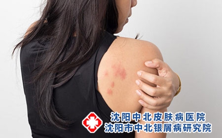 肩膀 癥狀