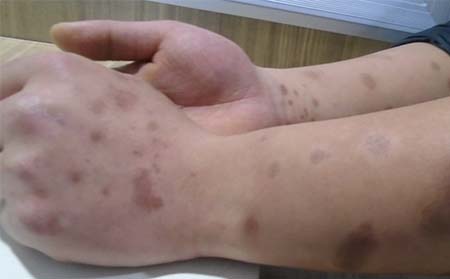 分享沈陽看銀屑病去什么專科醫院效果好圖片