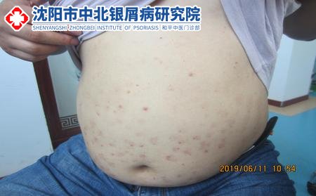 沈陽(yáng)較好的牛皮癬醫(yī)院在哪