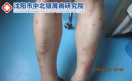沈陽看牛皮癬的醫院?牛皮癬的初期癥狀有哪些?