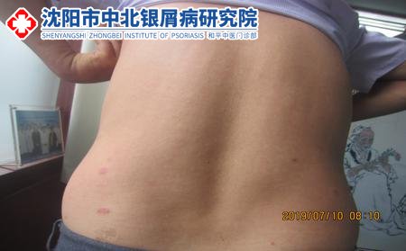 沈陽看牛皮癬到哪個(gè)醫(yī)院好