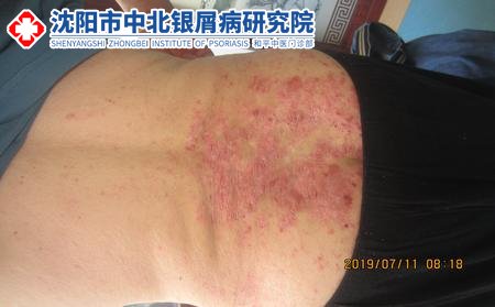 沈陽看牛皮癬比較好的醫院