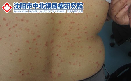 患牛皮癬到沈陽哪家醫(yī)院治療好