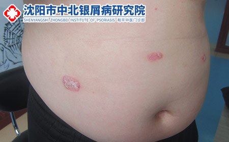 沈陽到哪里治療牛皮癬好