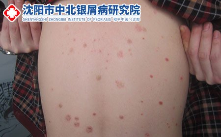 沈陽地區(qū)比較好的牛皮癬醫(yī)院