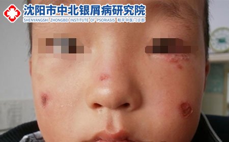 男人有銀屑病會遺傳孩子嗎