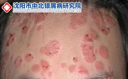 銀屑病圖片_沈陽中北銀屑病研究院好不好_沈陽中北研究院好不好_沈陽銀屑病醫院好不好