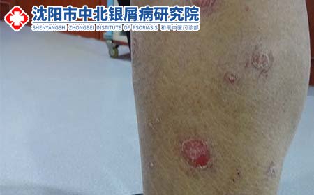 遼寧沈陽那個醫(yī)院牛皮癬治得好
