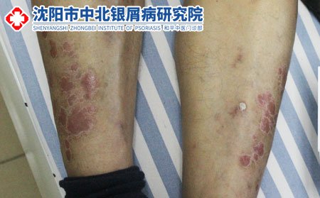 沈陽中北銀屑病研究院掛號沈陽銀屑病治療專業醫院