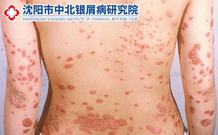 沈陽中北銀屑病研究院看要多少費(fèi)用