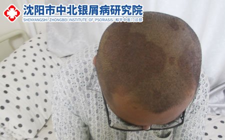 沈陽中北銀屑病研究院咋么樣